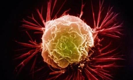 Breast cancer cell 
