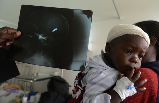 An X-ray film shows a bullet lodged in 18-month-old Satrin Osinya's brain, as he receives treatment in hospital in Nairobi.