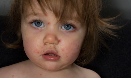 Girl with chickenpox