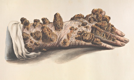 Tubercular leprosy on the hand