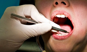 No more fillings as dentists reveal new tooth decay treatment