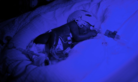 A baby in a neonatal unit