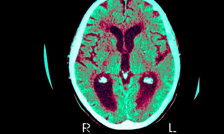 Scan to detect Alzheimer