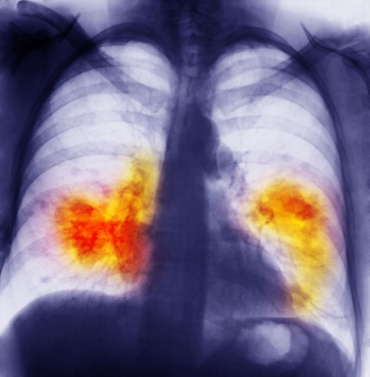 chest x-ray showing lung cancer
