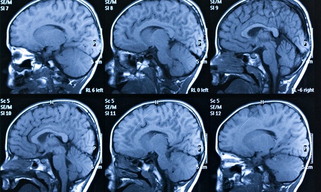 Drugs that make you super smart picture 2
