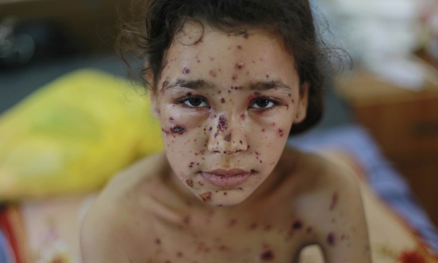 A child receiving treatment at the Shifa hospital for injuries caused by Israeli shelling