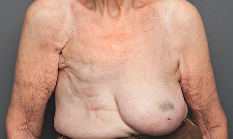 breasts: 101-year-old