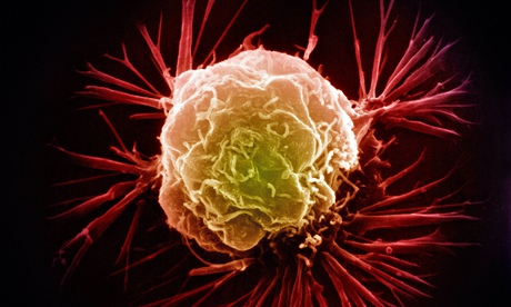 Breast cancer cell 