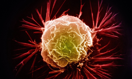 A breast cancer cell as scanned by an electron micrograph.