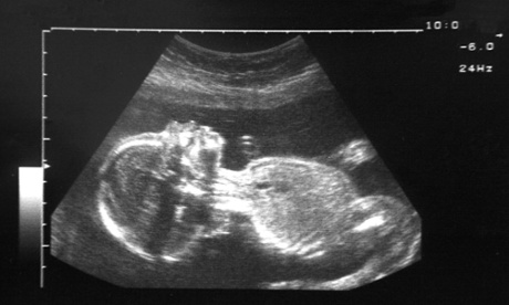 An ultrasound of a healthy 20-week foetus