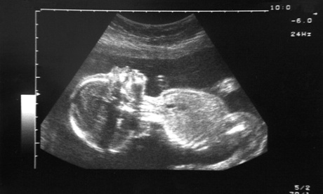ultrasound fetus