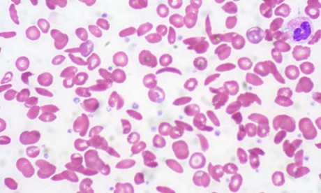 Close-up of blood smear of sickle cell anemia.