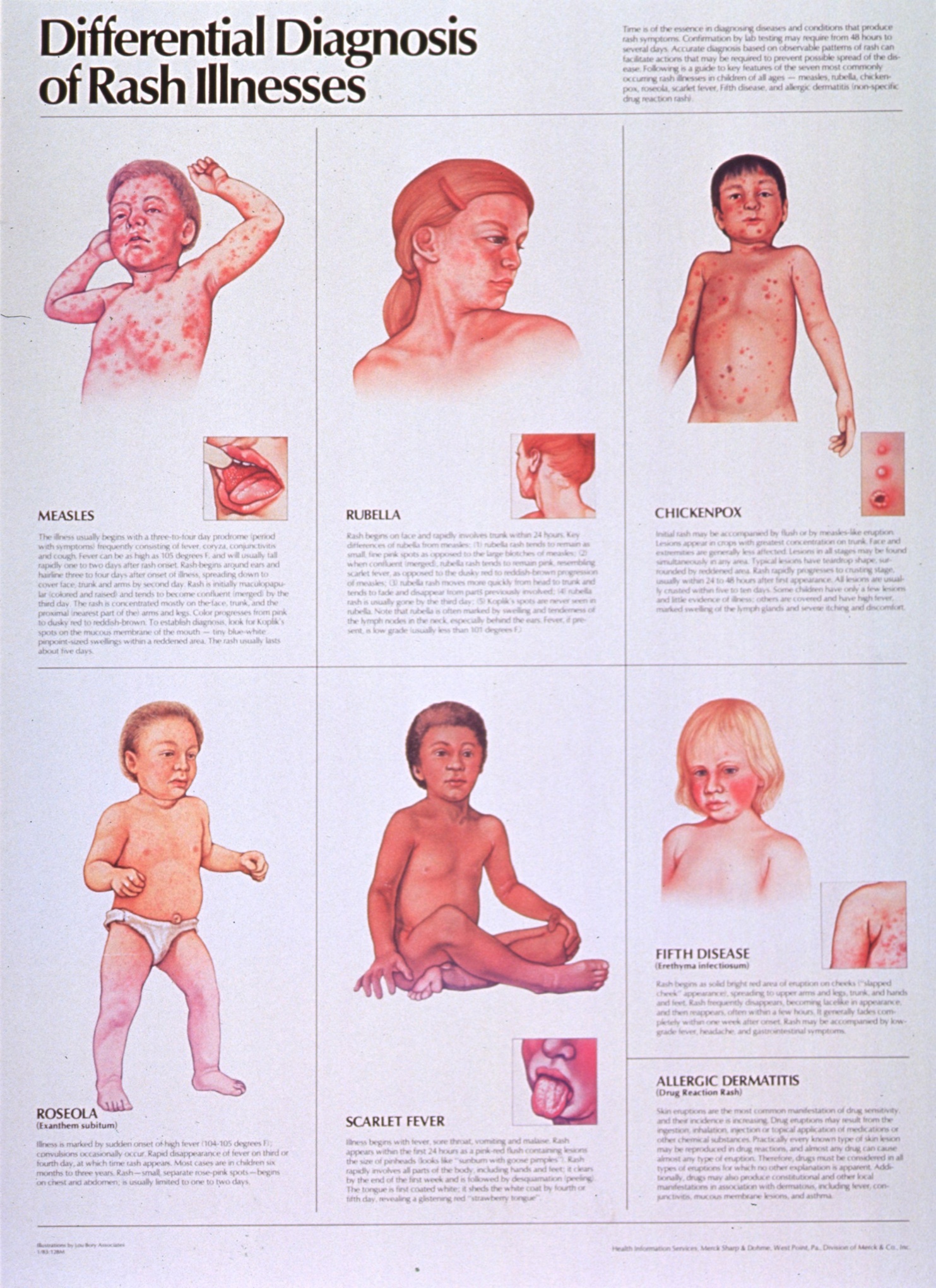 Measles prevention posters from around the world in pictures