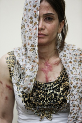 Andi before the operation.