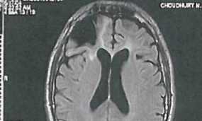 cecil clayton brain scan