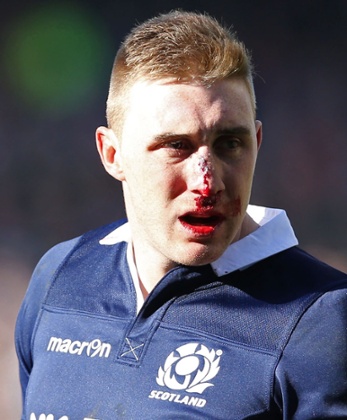 Scotland's wing Dougie Fife suffers a facial injury.