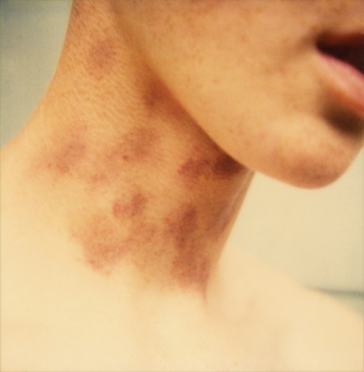 Hickeys on my neck, from Tones of Dirt and Bone.