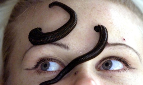 woman leeches