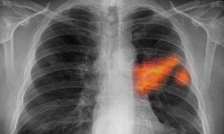 Chest x-ray