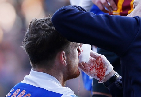 The physio attempt to stem the flow of claret streaming from Alex Pearce's nose.