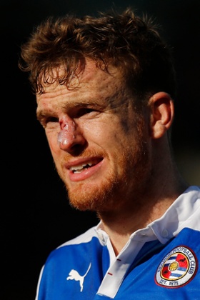 Alex Pearce mangled nose.