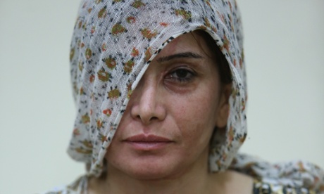 Andi, acid attack victim