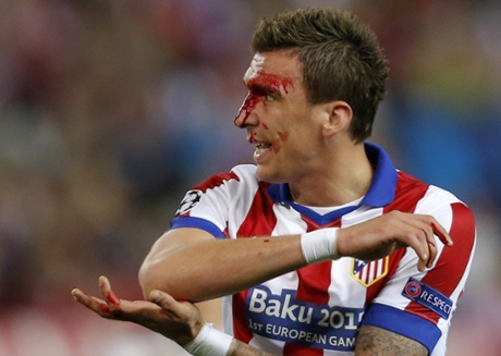Mario Mandzukic and his bloody fizzog.