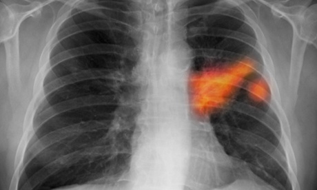 Chest x-ray of a smoker showing lung cancer in the left lung.
