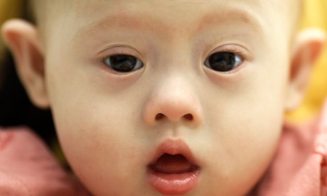 down's syndrome baby