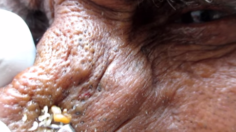 A screenshot of Dr. Yadav extracting blackheads