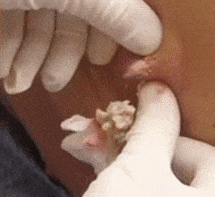 grossest-cyst-removal