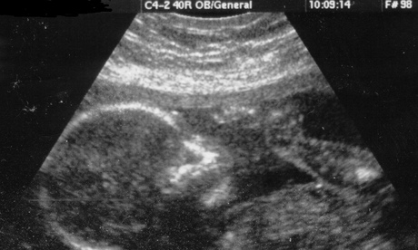 ULTRASOUND SCAN OF A FOETUS IN THE WOMB