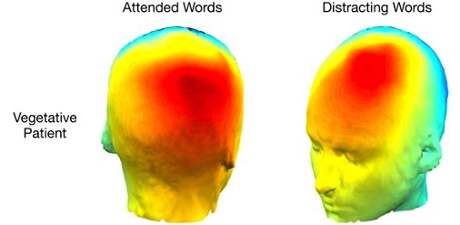 This scan depicts patterns of the vegetative patient's electrical activity over the head when they attended to the designated words, and when they were distracted by novel but irrelevant words.