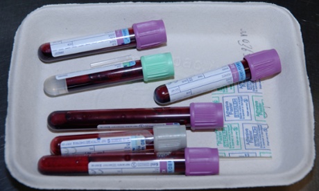 New ovarian cancer test twice as effective as existing methods