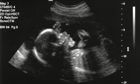 Ultrasonic image of a five-month-old foetus.