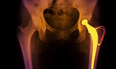 Hip replacement x-ray