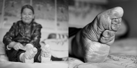 Su Xi Rong, 75 in 2008, whose feet were bound as a girl.