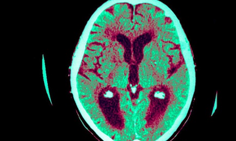 Alzheimer's disease brain scan