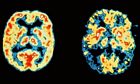Brain scans of patients in good health (left) and with Alzheimer's disease (right), with high brain 