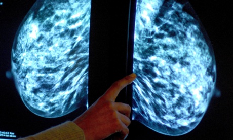 A mammogram showing a breast tumour. Around half of all women diagnosed with breast cancer each year could potentially benefit from the latest findings.