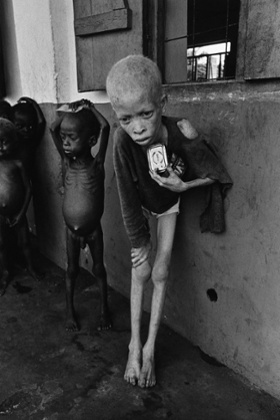 An albino boy in a Biafra orphanage, 1969.