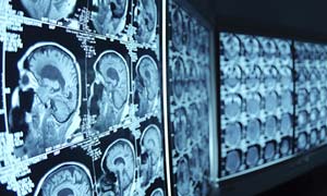 Brain CAT scans