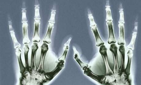 X-ray of Hands