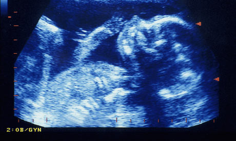 Human foetus feels no pain before 24 weeks, study says