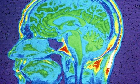 MRI scan of the brain