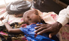 Somali childnchild in refugee hospital