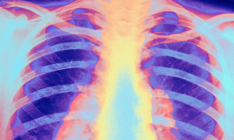 X-ray of human chest showing pulmonary tuberculosis 