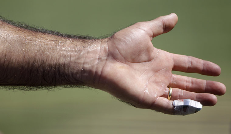 Ashes 2010: Ricky Ponting's broken finger