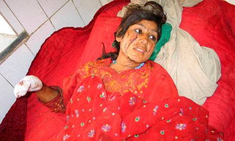 An Afghan girl in Helmand after being injured in an air strike by coalition forces in June 2007