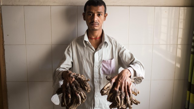 Sex Video Fastime - Bangladeshi girl could be first female with 'tree man' syndrome | Global  health | The Guardian